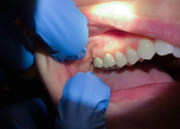 Best Emergency Dental Care for Sports Injuries in Keary, NE